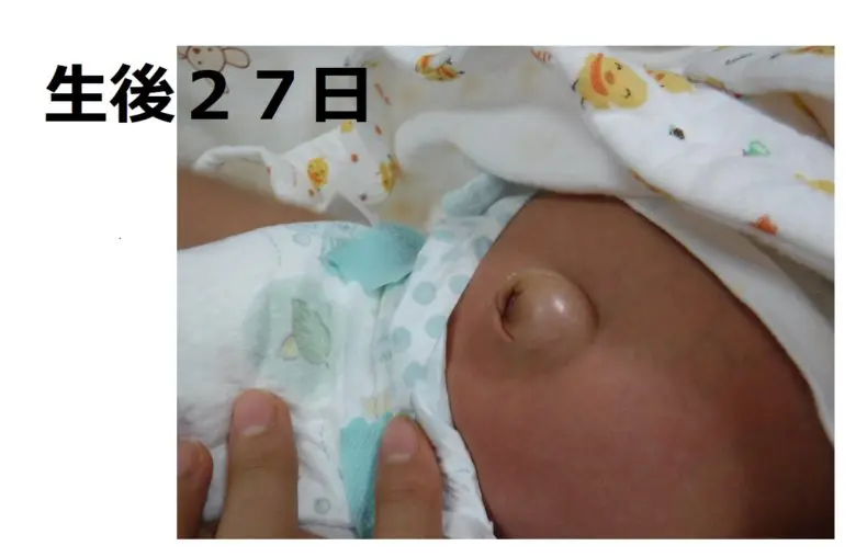 でべそ生後27日