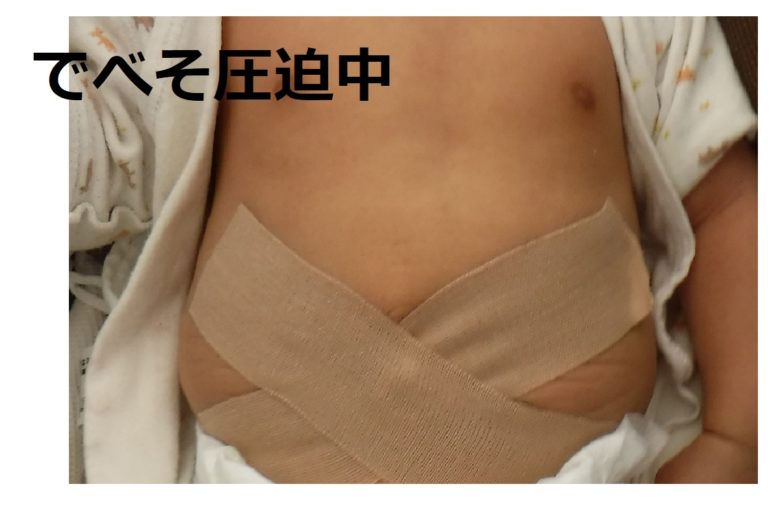 でべそ圧迫中(コットンボール在中)