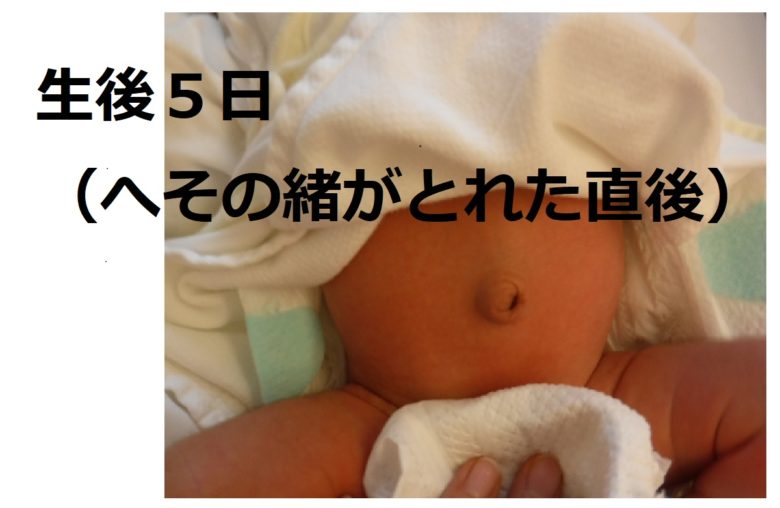 でべそ生後5日(へその緒がとれた直後)