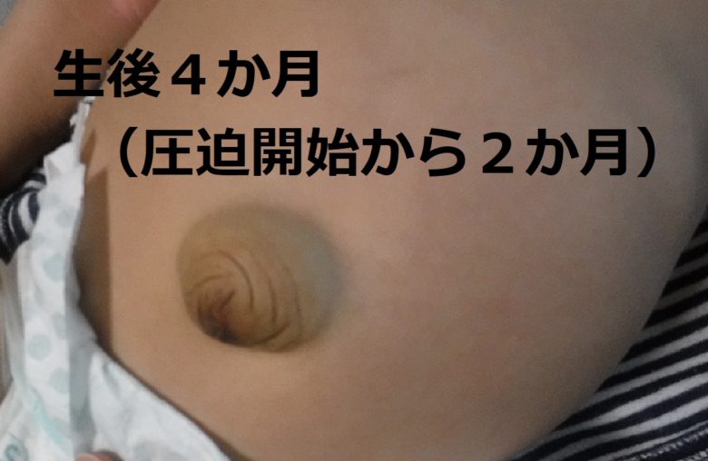 でべそ生後4か月(圧迫から2か月)