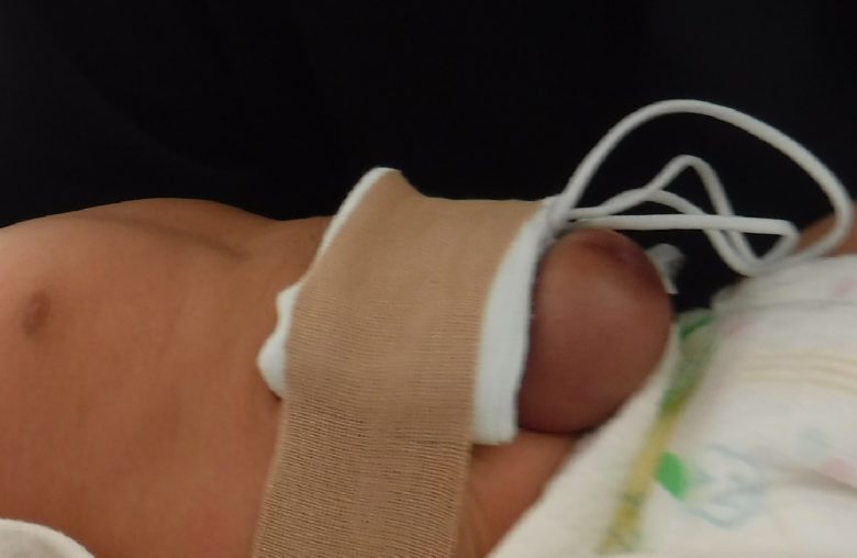 でべそ圧迫失敗(ガーゼ)